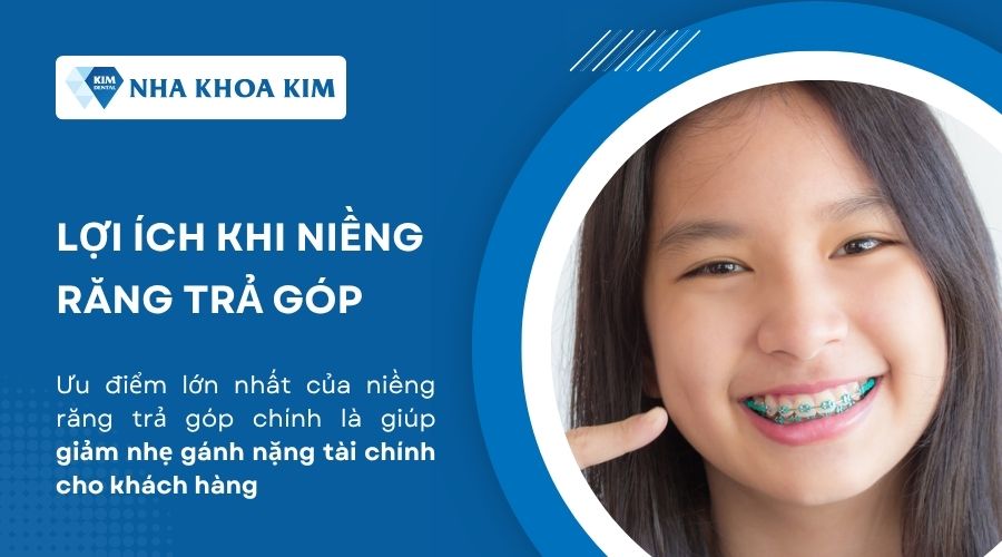 Lợi ích khi niềng răng trả góp