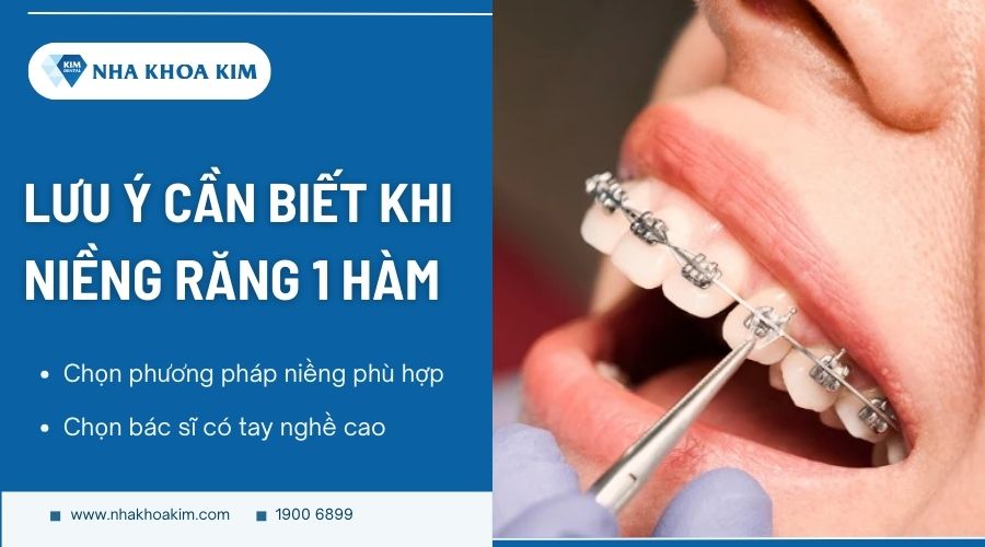 Lưu ý khi niềng răng 1 hàm