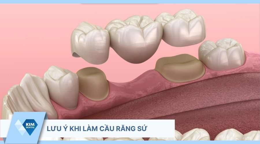 lưu ý sau khi làm cầu răng