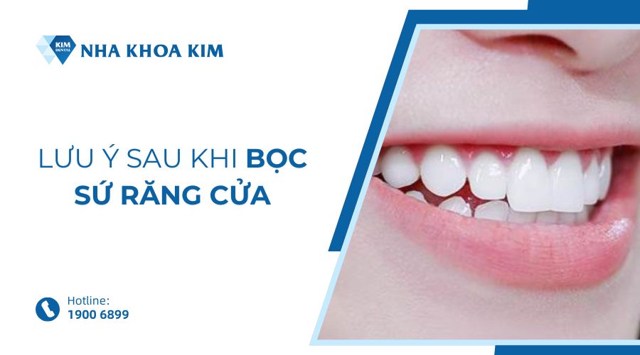Những lưu ý sau khi bọc sứ răng cửa