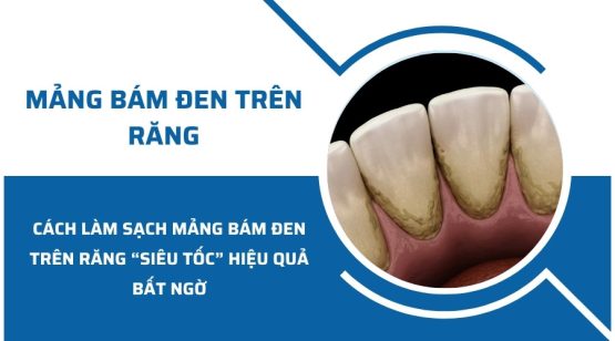 Cách tẩy mảng bám đen trên răng hiệu quả tại nhà