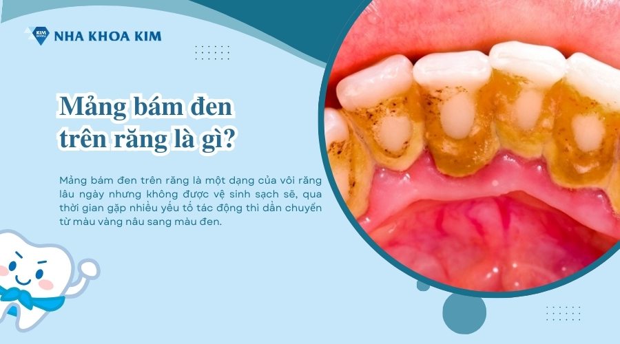 Mảng bám đen trên răng là gì?