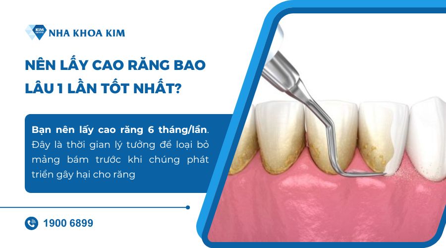Nên lấy cao răng bao lâu 1 lần?