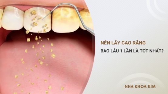 Nên lấy cao răng bao lâu một lần là tốt nhất?