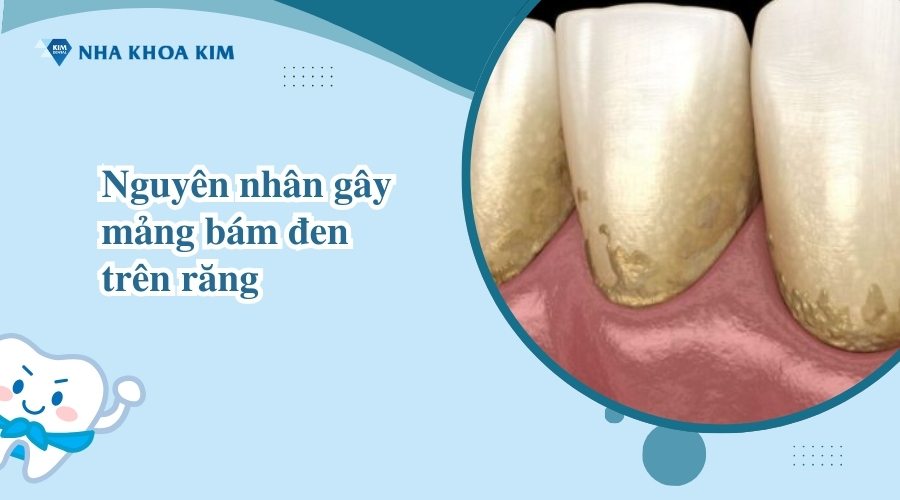 Nguyên nhân gây mảng bám đen trên răng