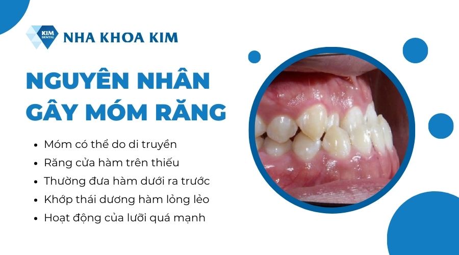nguyên nhân gây móm răng