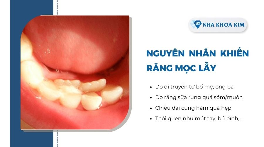 Nguyên nhân khiến răng mọc lẫy