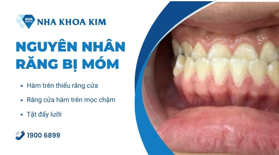 Nguyên nhân khiến răng bị móm
