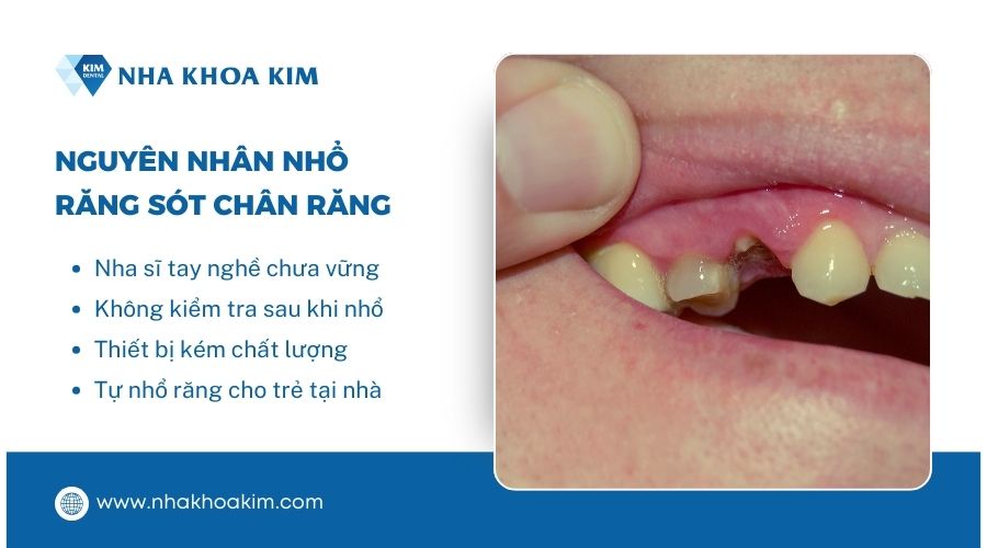 Nguyên nhân nhổ răng còn sót chân răng 