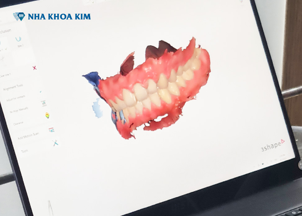 Mô hình 3D của dấu răng hiển thị rõ ràng, chi tiết trên màn hình