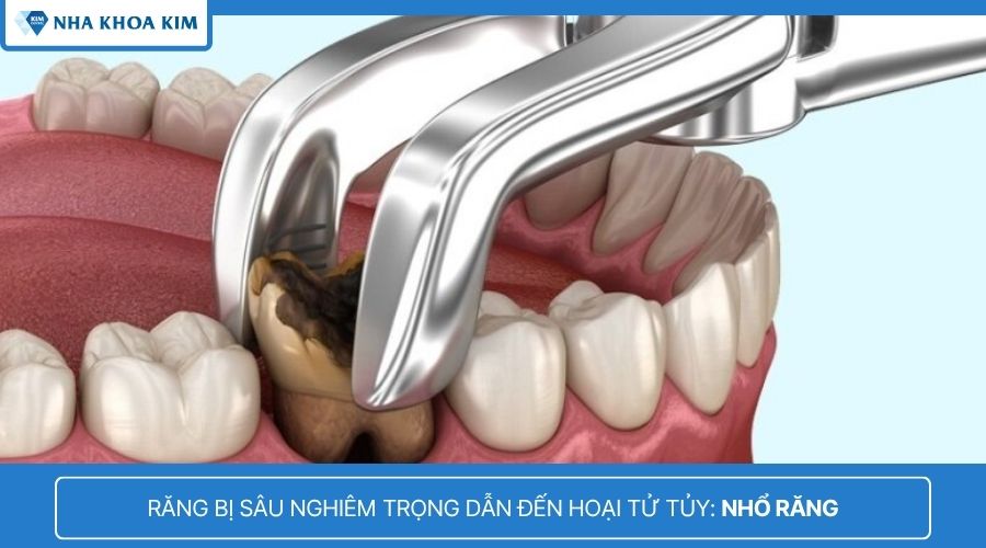 nhổ răng sâu 