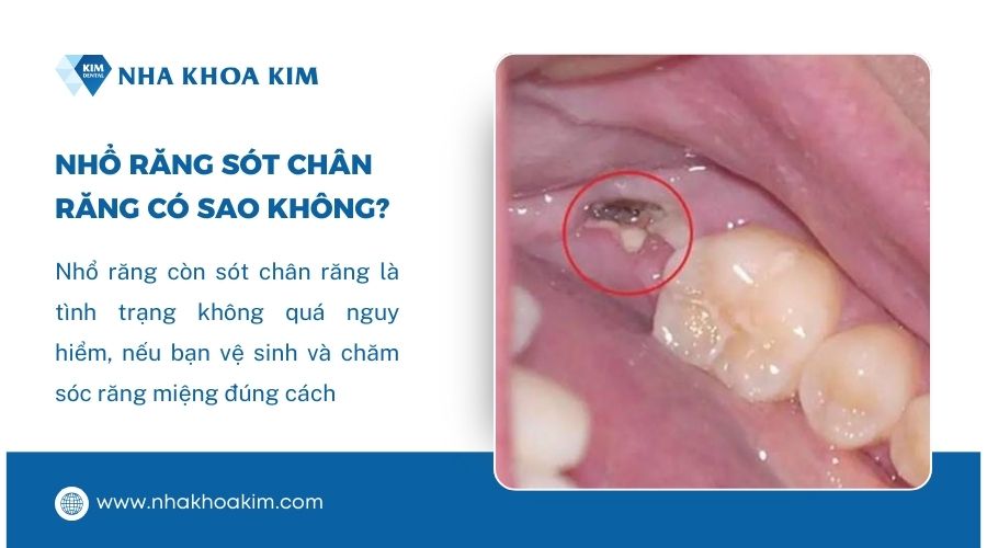 nhổ răng còn sót chân răng có sao không?