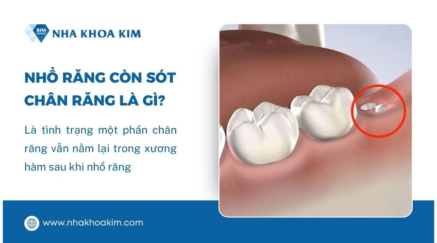 Nhổ răng còn sốt chân răng là gì