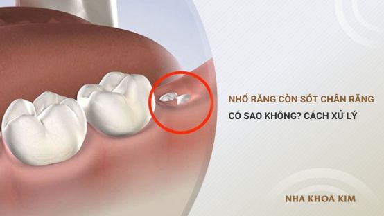 Nhổ răng còn sót chân răng có sao không? Cách xử lý an toàn