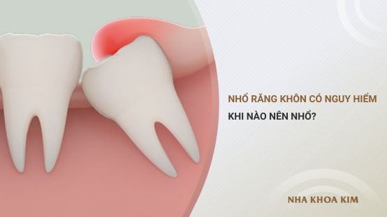 Nhổ răng khôn có nguy hiểm không? Khi nào nên nhổ?
