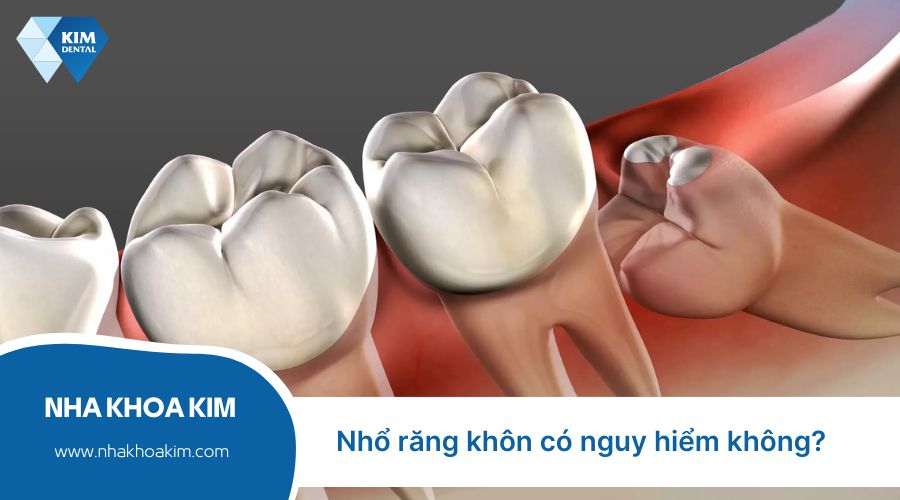 nhổ răng khôn có nguy hiểm không