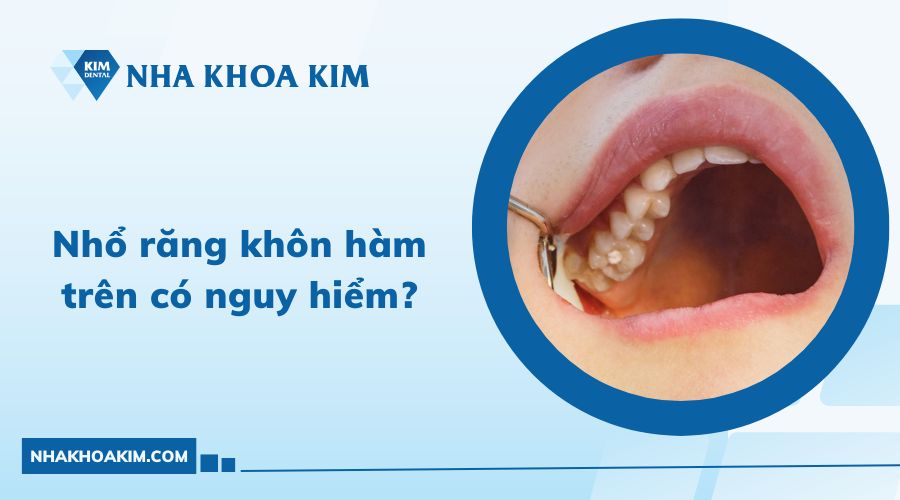 Nhổ răng khôn hàm trên có nguy hiểm không