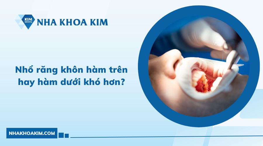 Nhổ răng khôn hàm trên hay hàm dưới khó hơn