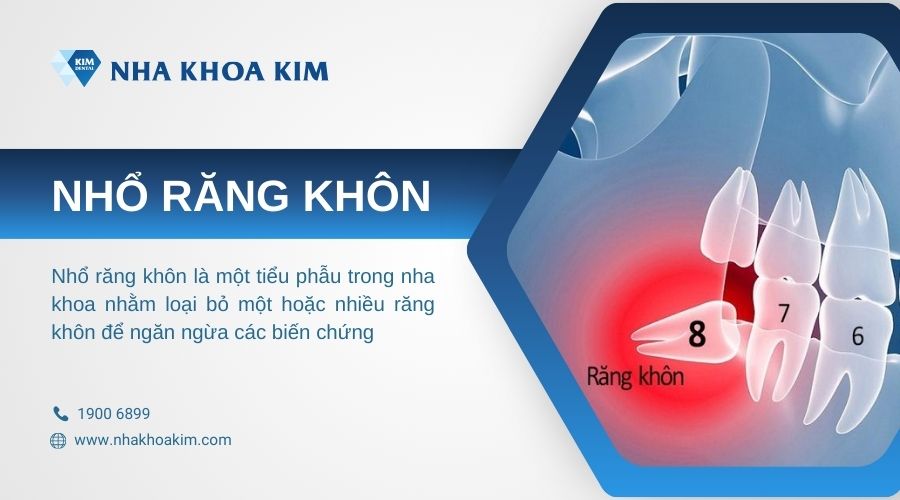 nhổ răng khôn là gì
