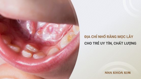 Địa chỉ nhổ răng mọc lẫy cho trẻ uy tín, chất lượng