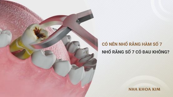 Có nên nhổ răng hàm số 7 không? Có đau không?
