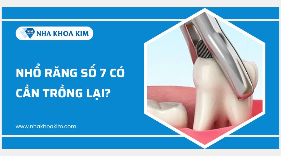nhổ răng số 7 bao lâu thì trồng lại được