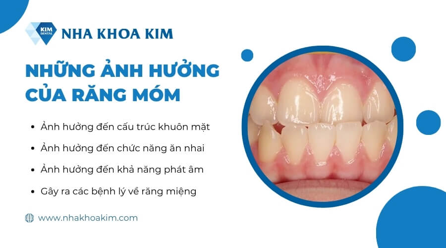Những ảnh hưởng của răng móm