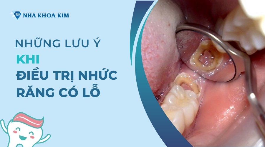 Những lưu ý khi điều trị nhức răng có lỗ