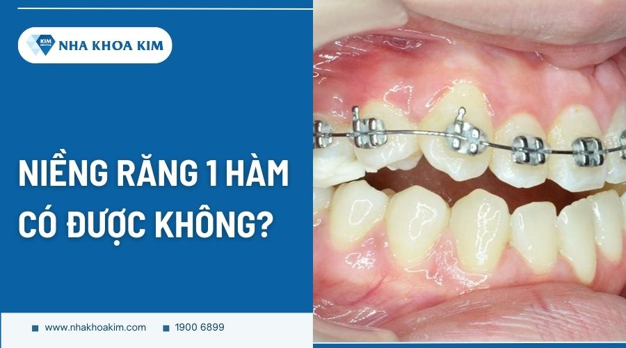 Niềng răng 1 hàm có được không?
