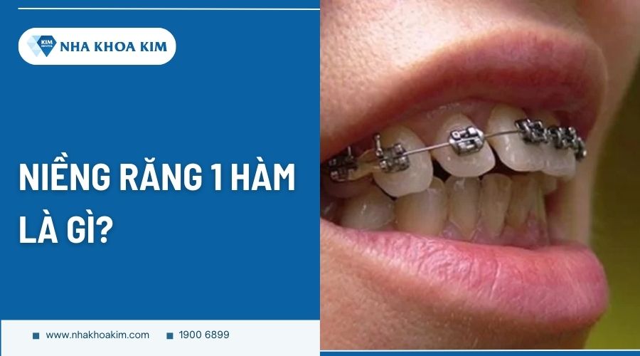 Niềng răng 1 hàm là gì?