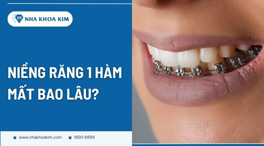 Niềng răng 1 hàm mất bao lâu?