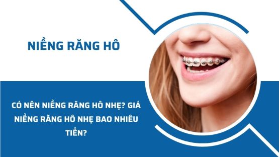 Có nên niềng răng hô nhẹ? Giá niềng răng hô nhẹ bao nhiêu tiền?