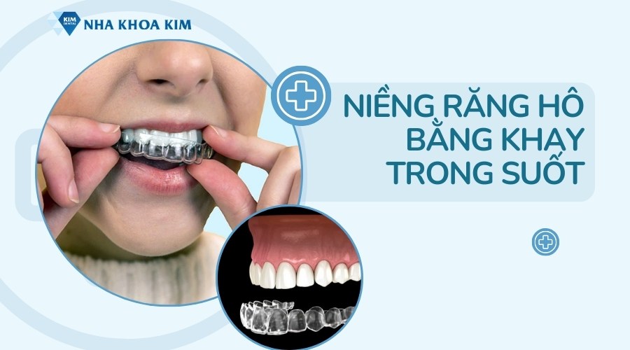 Niềng răng hô bằng khay trong suốt