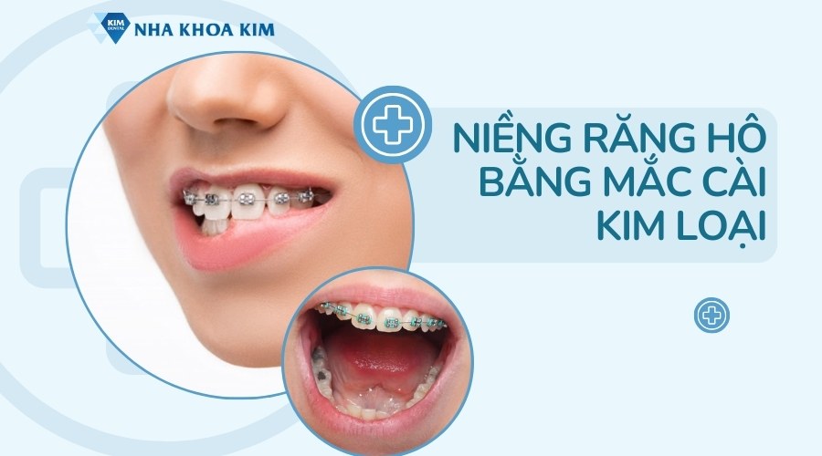 Niềng răng hô bằng mắc cài kim loại