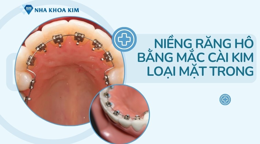 Niềng răng hô mắc cài mặt trong (mặt lưỡi)