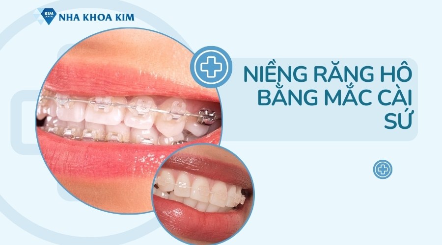 Niềng răng hô mắc cài sứ