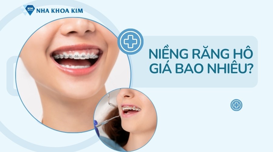 Chi phí niềng răng hô bao nhiêu tiền?