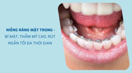 Niềng răng mặt trong (mặt lưỡi) tốt không? Giá bao nhiêu?