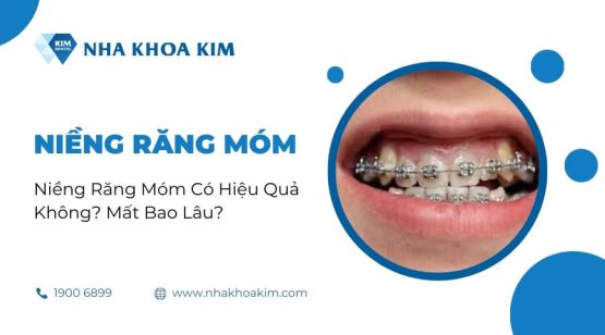 Niềng Răng Móm Có Hiệu Quả Không? Mất Bao Lâu?