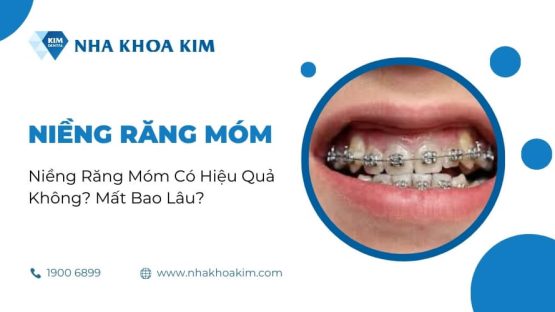 Niềng Răng Móm Có Hiệu Quả Không? Mất Bao Lâu?