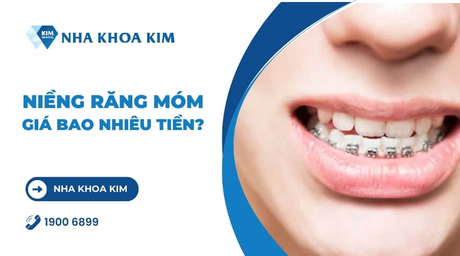 Chi Phí Niềng Răng Móm Bao Nhiêu Tiền? Bảng Giá Mới Nhất 2024