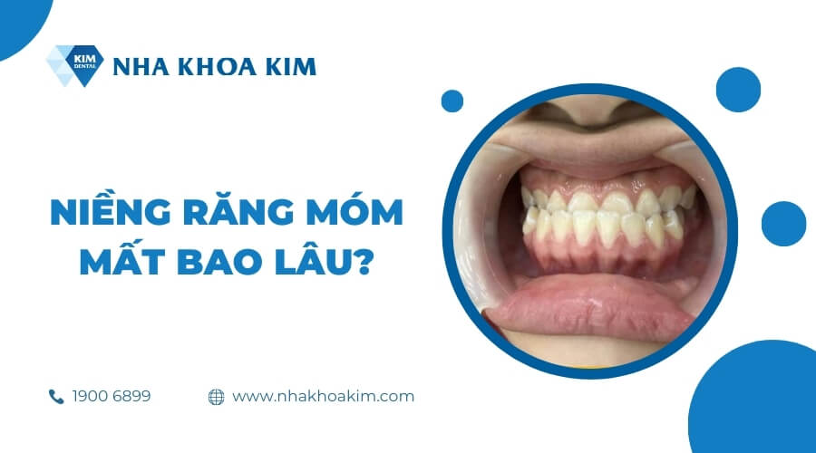 Niềng răng móm mất bao lâu?