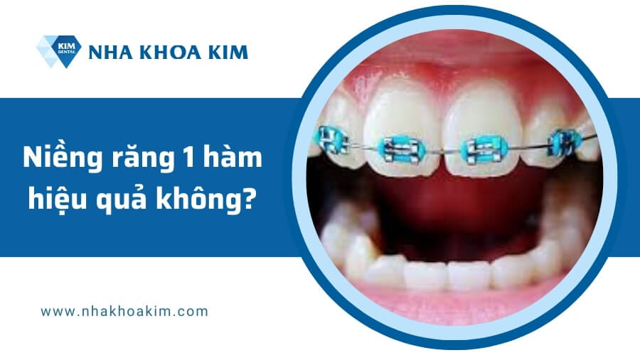 Niềng răng 1 hàm có hiệu quả không?