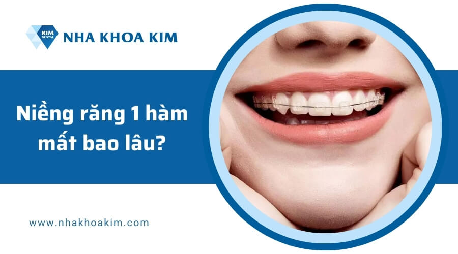 Niềng răng 1 hàm mất bao lâu?