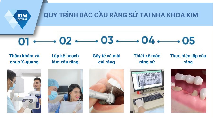 quy trình bắc cầu răng sứ