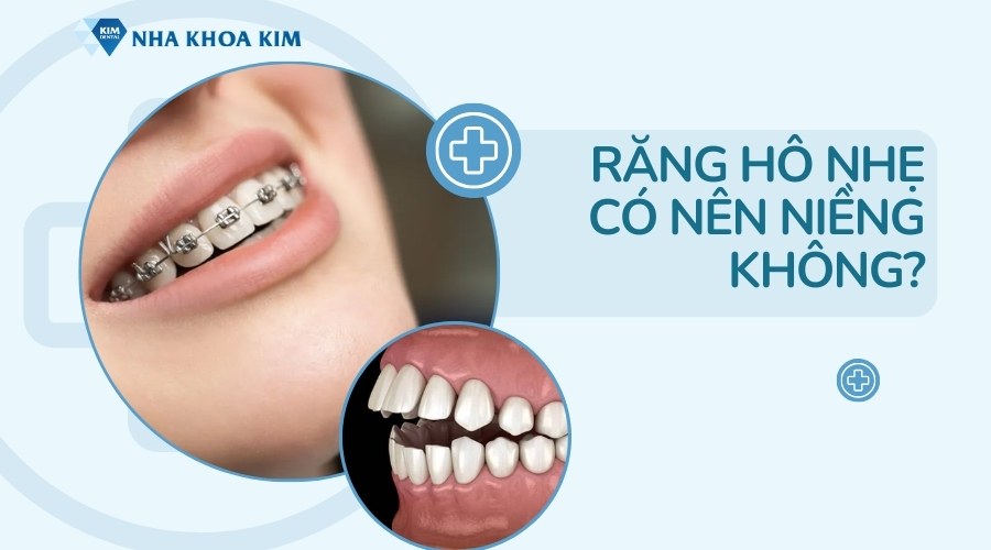 Răng hô nhẹ có nên niềng không?