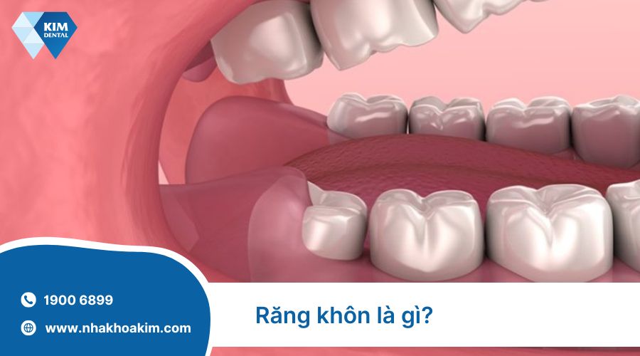 răng khôn là gì