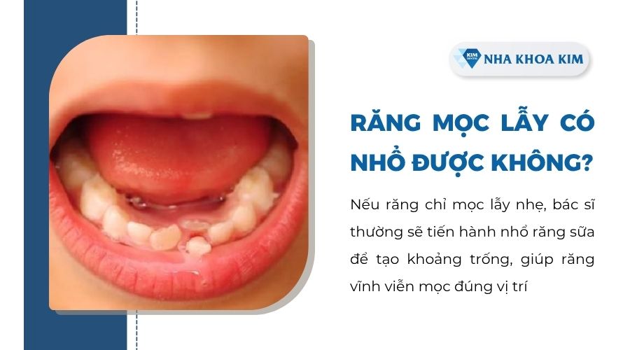 Răng mọc lẫy có nhổ được không?