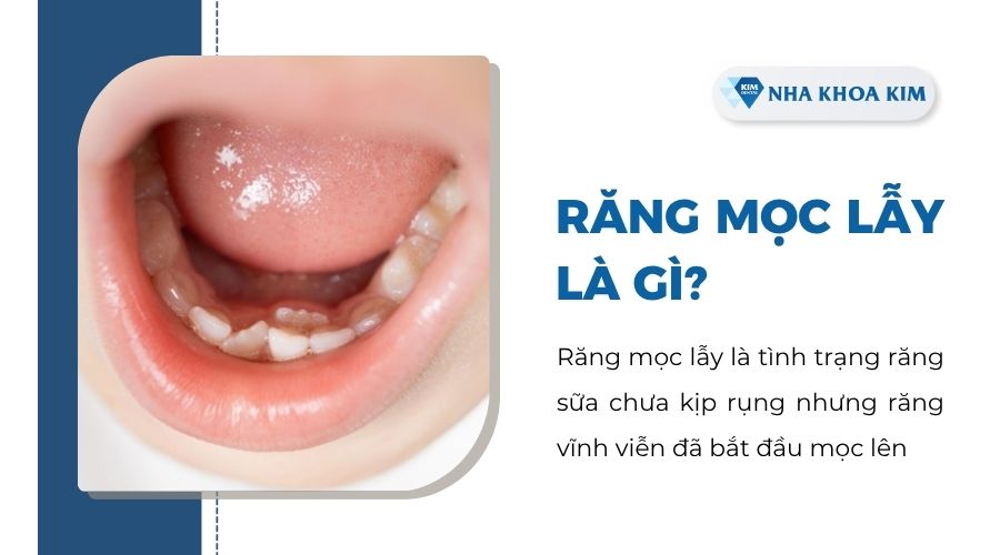 Răng mọc lẫy là gì?