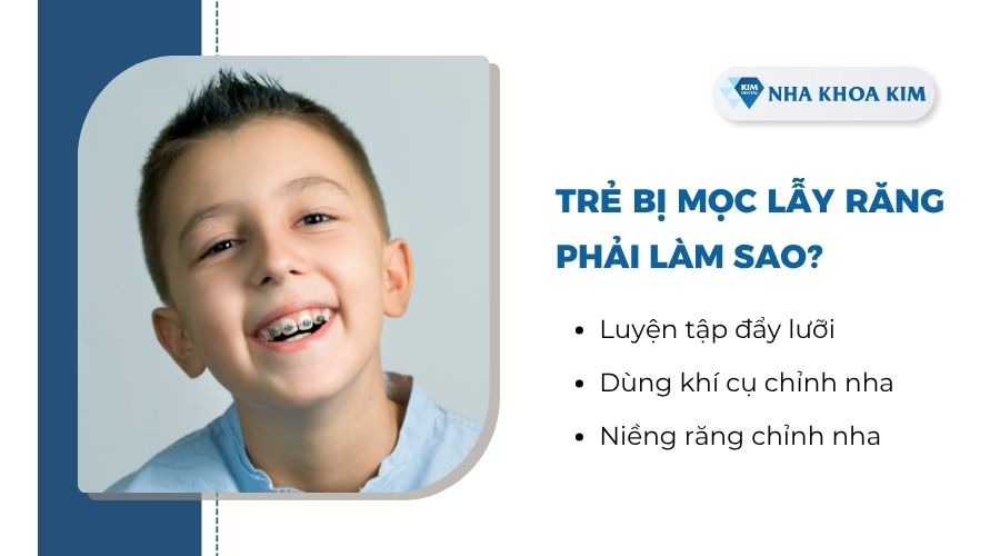 Trẻ bị răng mọc lẫy phải làm sao?